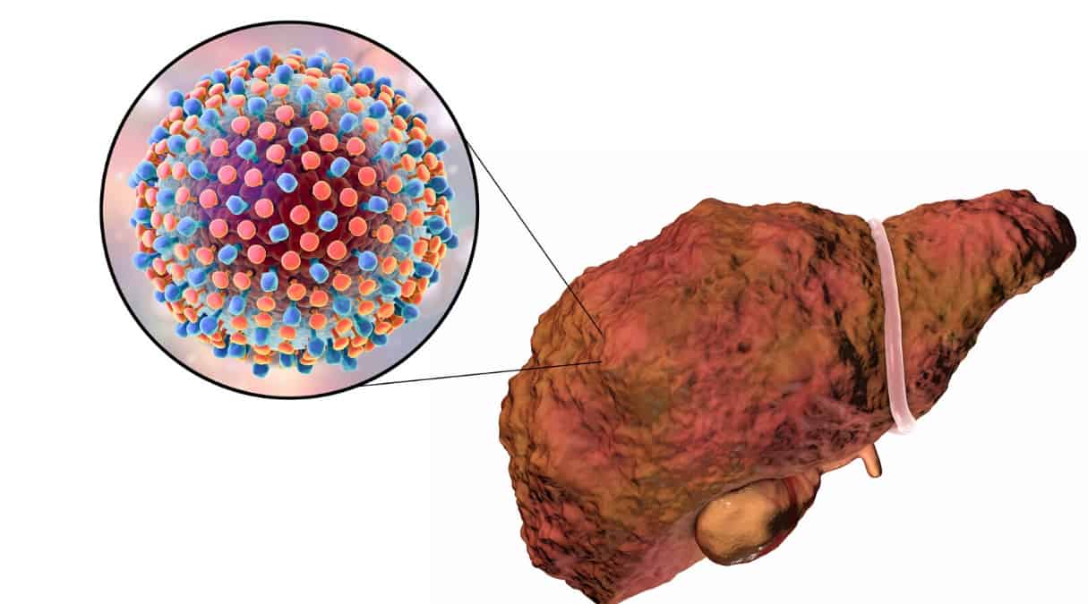 Пересадка печени при циррозе