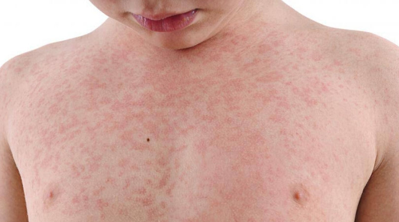 гепатит с сыпь сыпь при гепатите