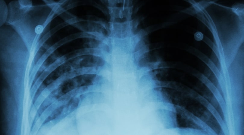 Туберкулез и гепатит при ВИЧ