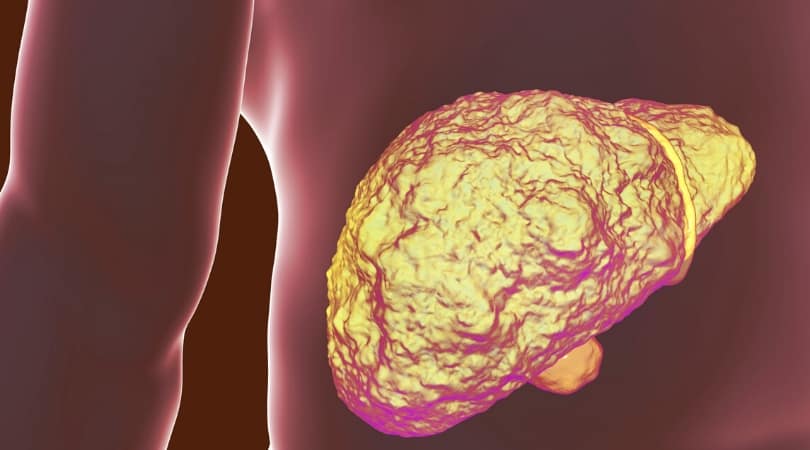 Цирроз печени и алкоголь при гепатите С
