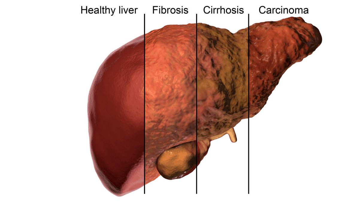 Последняя стадия цирроза печени