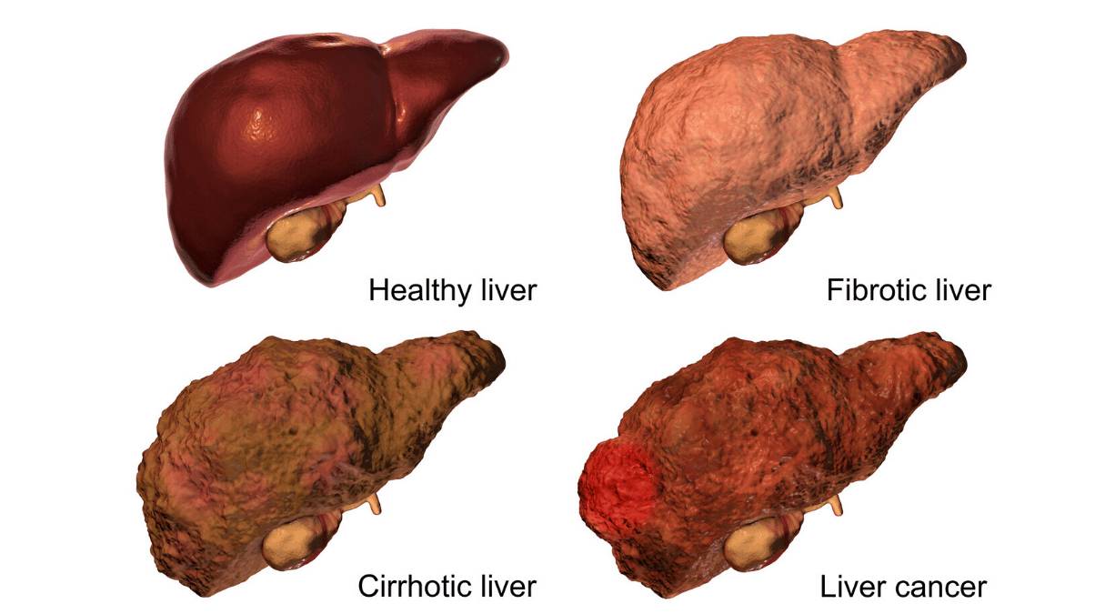 Последняя стадия цирроза печени