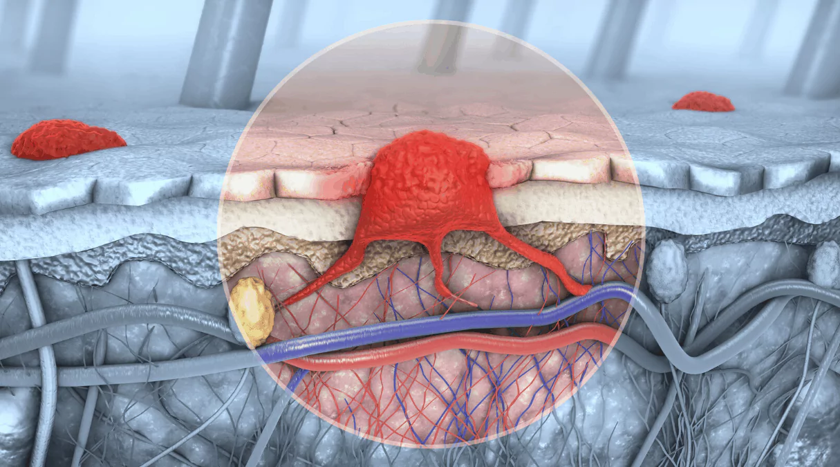 Метастатический рак: что это такое?