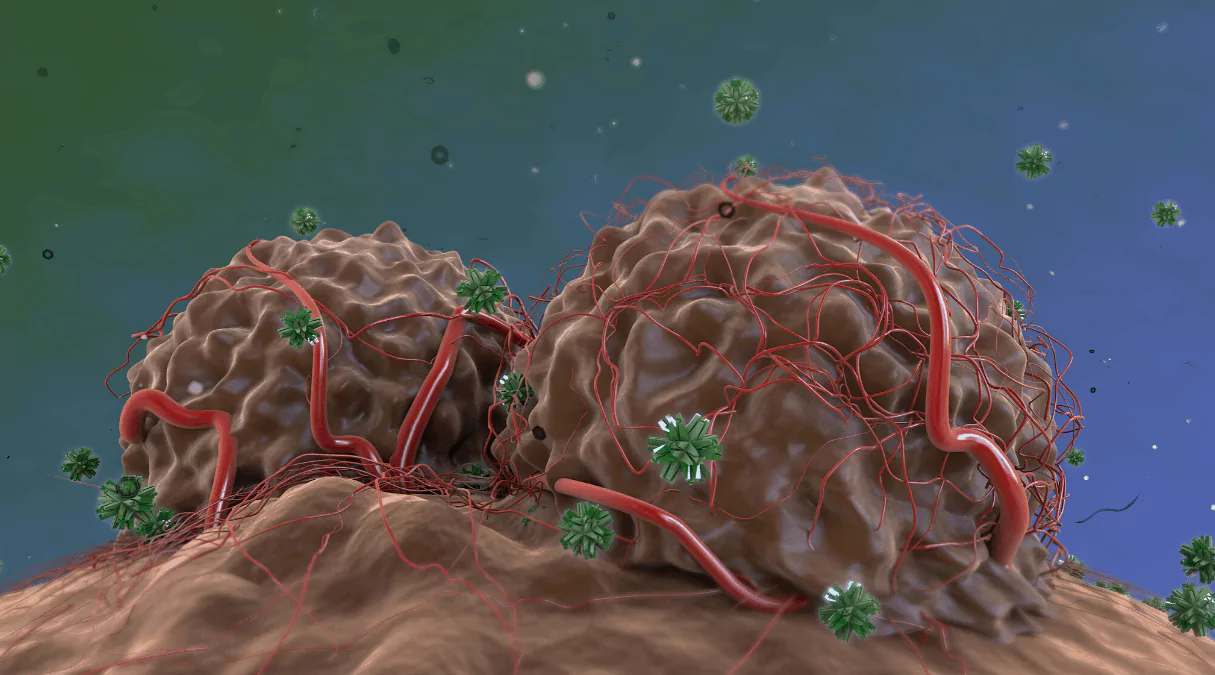 Метастатический рак: что это такое?