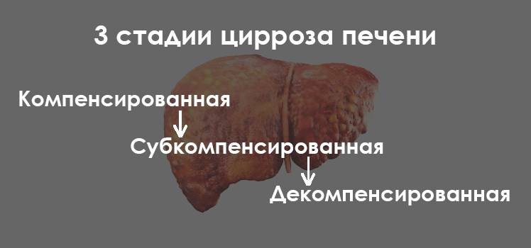 3 стадии цирроза печени