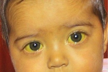 Симптомы гепатитов у детей