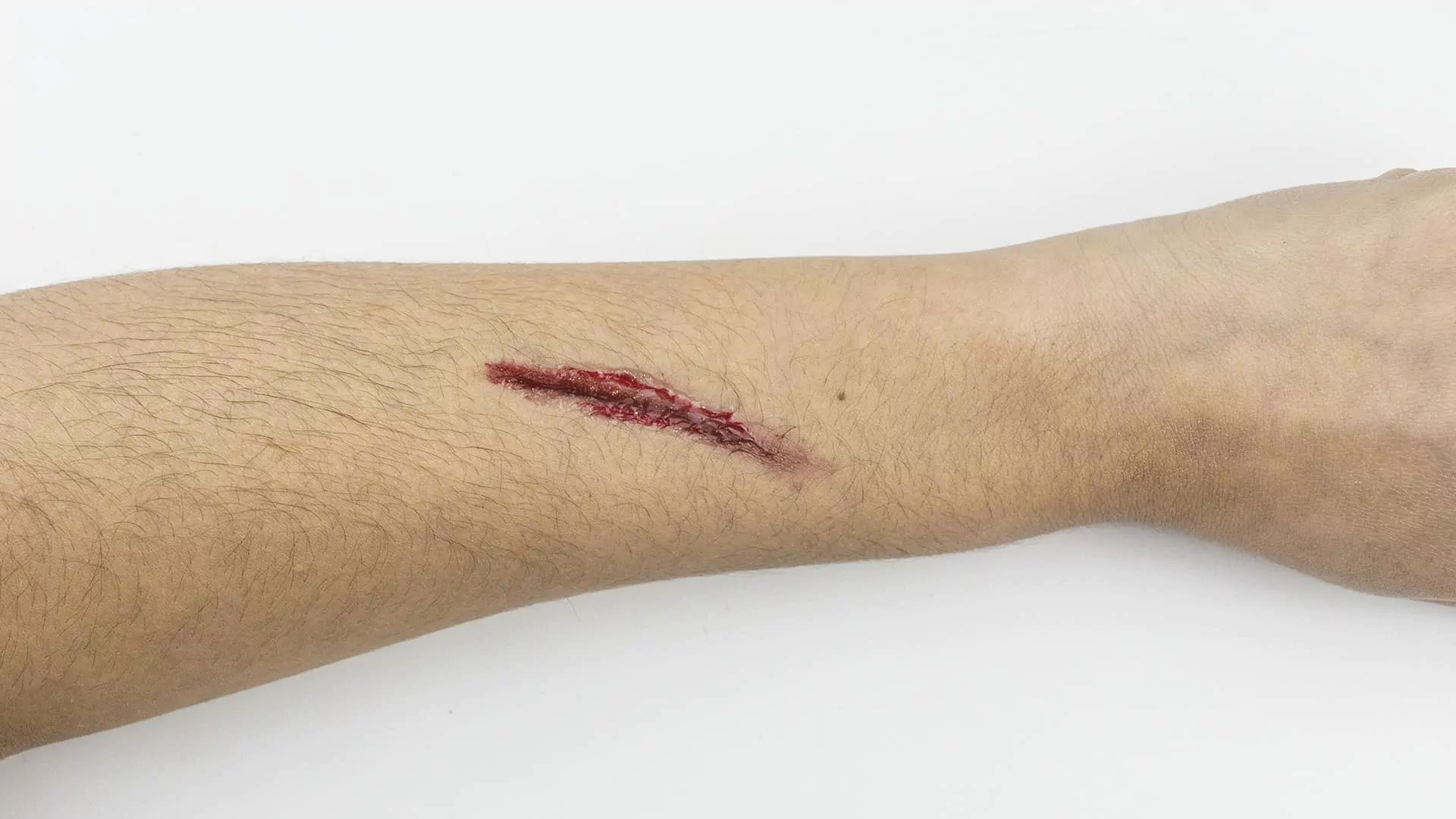 порезы при гепатите с гепатит с через рану