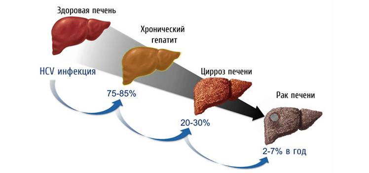 Что покажет Фиброскан Что покажет Фиброскан