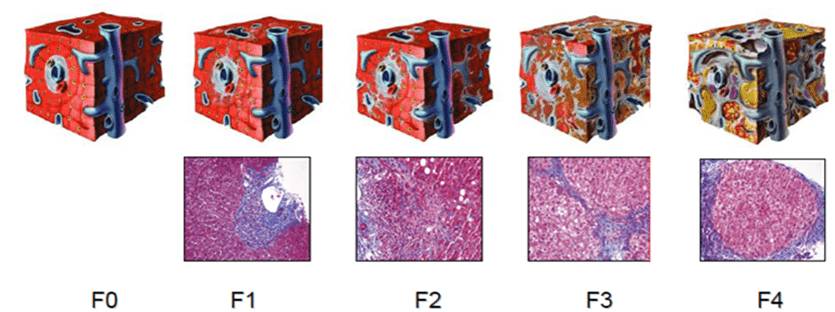 фиброз печени от Ф1 до Ф4 фиброз печени 1, 2, 3, 4 степень