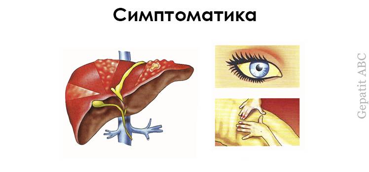 Фиброз печени симптомы Симптомы фиброза