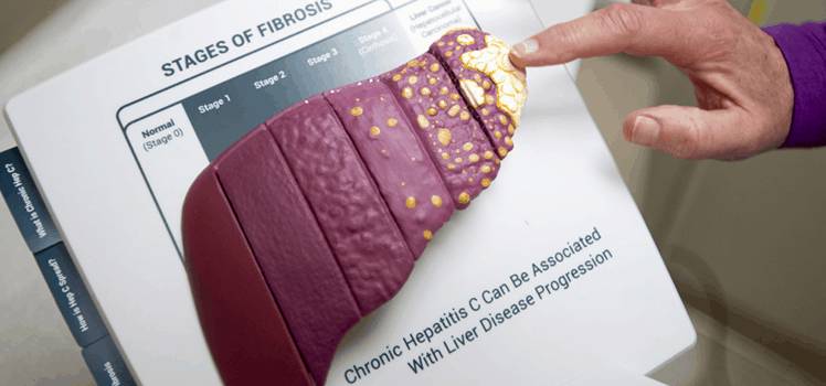 фиброз печени 3 степени Диагноз f3 стадия фиброза печени