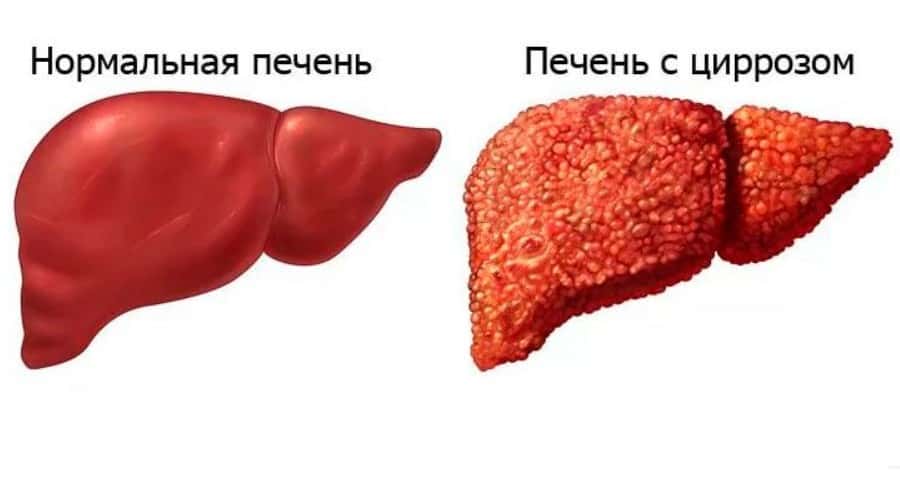 печень цирроз фиброз f4 цирроз