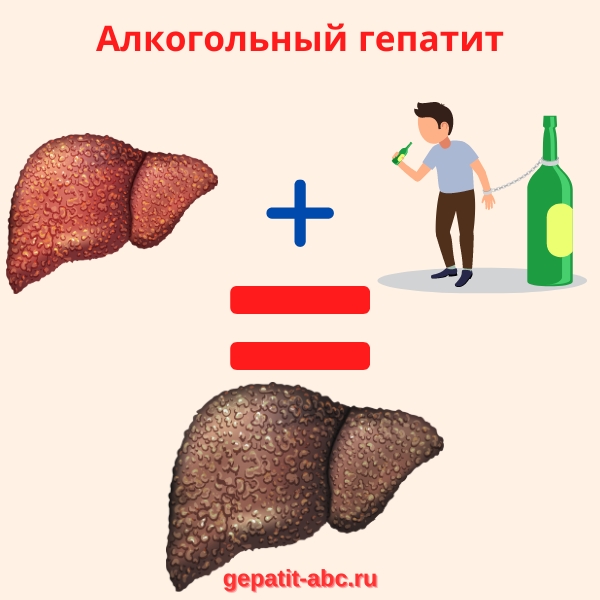 Алкогольный гепатит