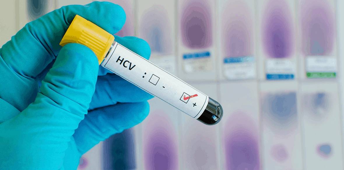 анализ гепатит С качественный пцр качественный на гепатит с