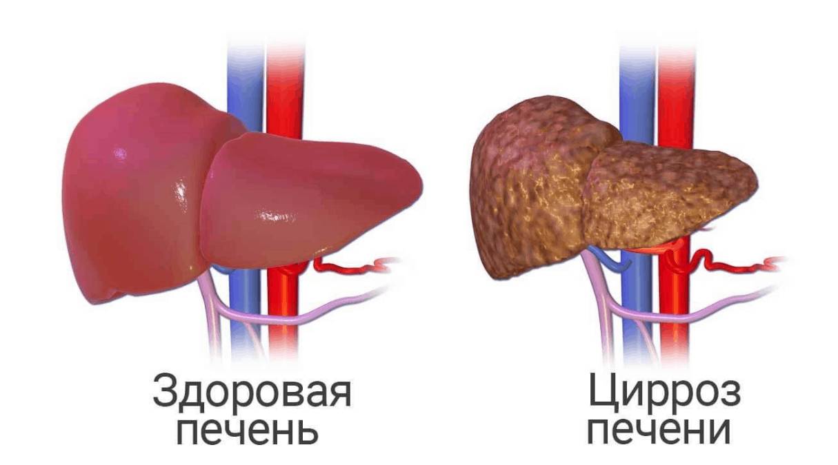 Цирроз печени Цирроз печени